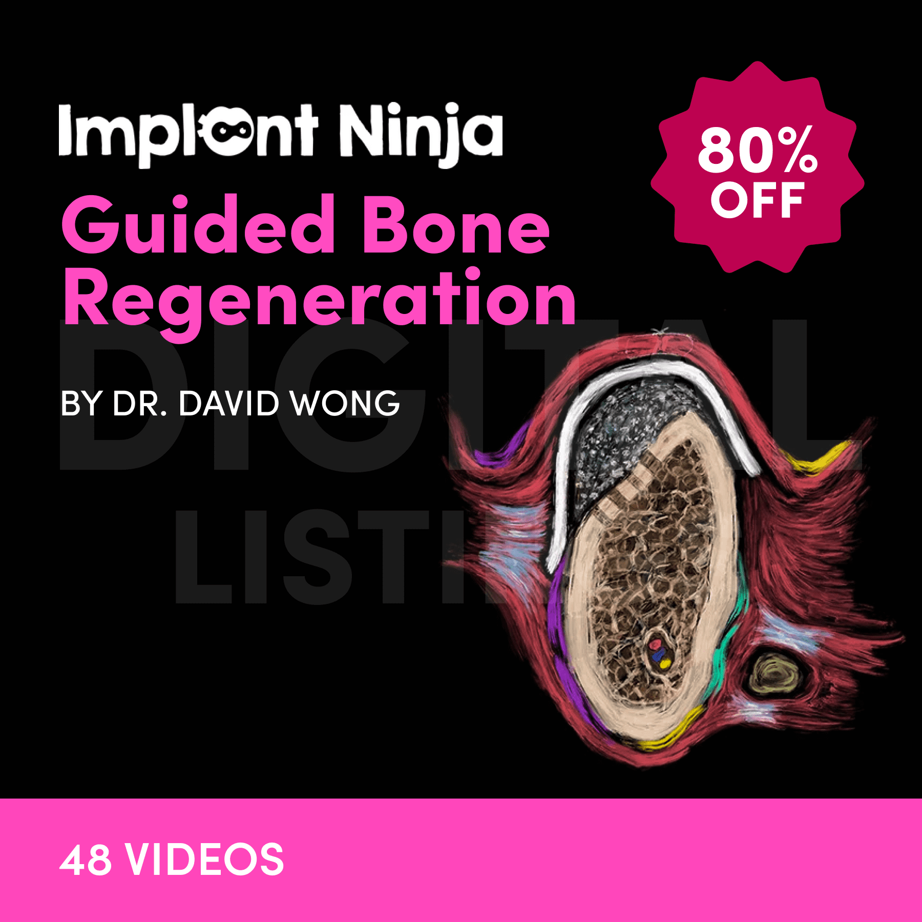 Implant Ninja, Guided Bone Regeneration